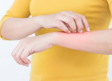 zanzare, punture insetto, rimedi naturali