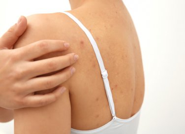 acne estiva, sole, rimedi naturali