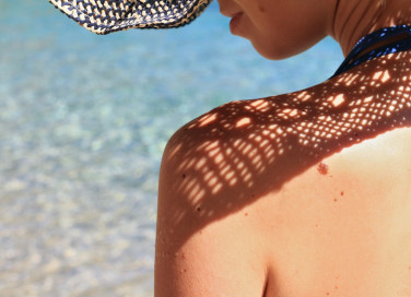 macchie della pelle, melasma, rimedi naturali
