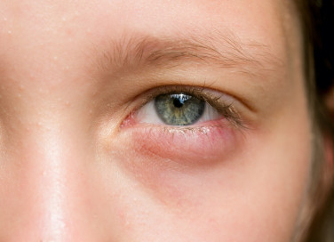 occhio gonfio, rimedi naturali, soluzioni erboristiche