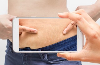 Smagliature della pelle, come prevenirle e i rimedi naturali per combatterle