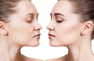 Come coprire un foruncolo con il correttore