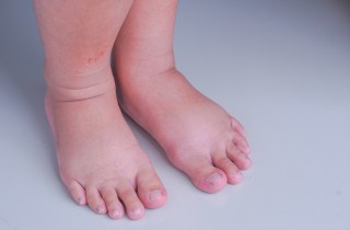 Cosa fare se il bambino cammina con i piedi verso l'interno?