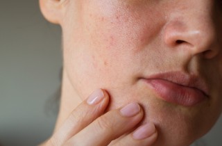 6 trattamenti per le macchie scure che funzionano