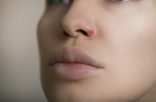 Come curare la pelle secca intorno al naso