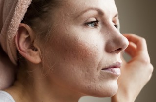 Acne dopo la gravidanza: che cos’è e quali sono le cause?