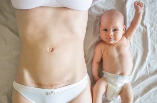 Cicatrice del parto cesareo: come aiutare la guarigione