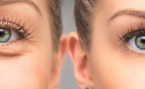 Borse sotto gli occhi