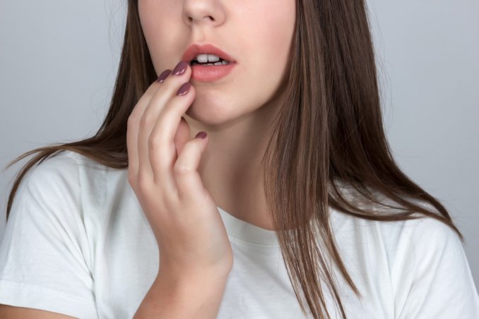 herpes labiale, rimedi naturali, cure