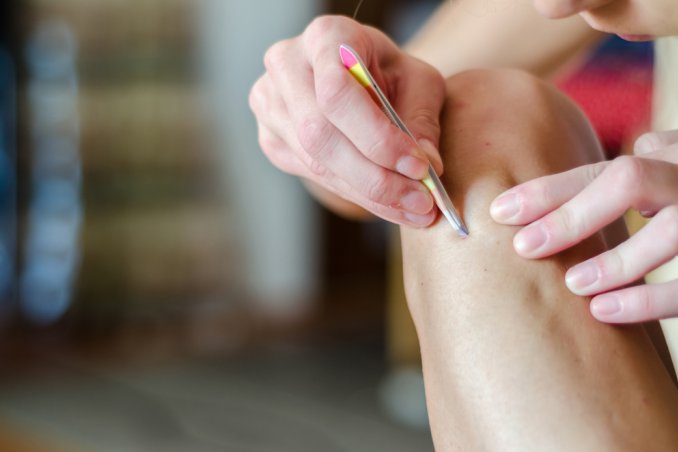 peli incarniti, pinzetta